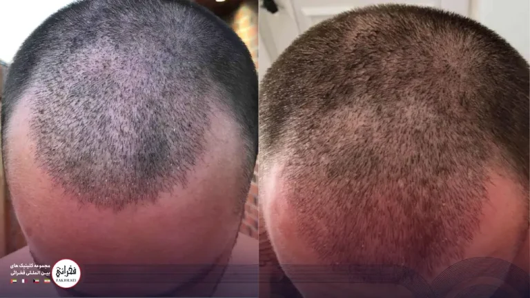 ۱۴ روز بعد از کاشت مو؛ نکات مراقبتی و تغییرات مهم