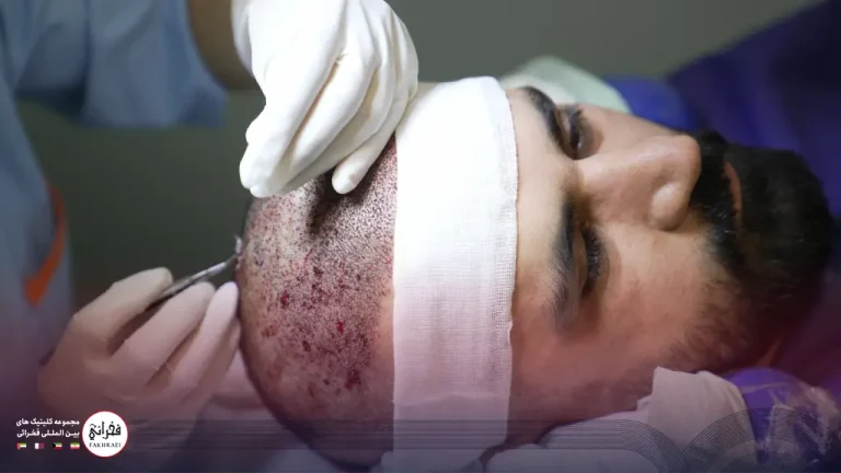 کاشت مو چند ساعت طول میکشد