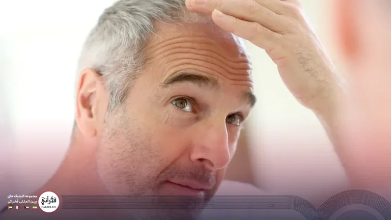 بهترین سن برای کاشت مو چقدر است؟ دیر شده یا هنوز زود است؟