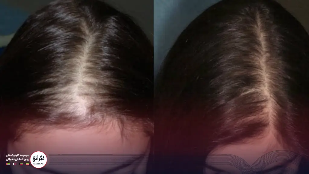 کاشت مو برای موهای کم پشت زنان