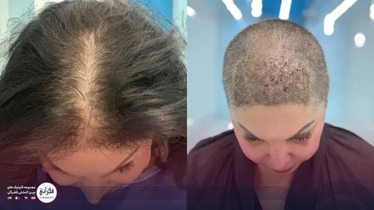 آیا کاشت مو برای زنان ممکن است؟ | شرایط، عکس و هزینه