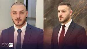 نمونه کاشت مو در تهران