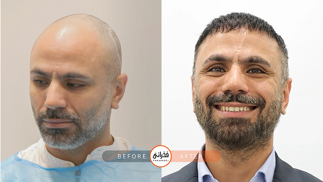 سن مناسب کاشت مو