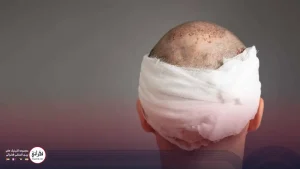 بعد از کاشت مو چند روز باید استراحت کرد؟