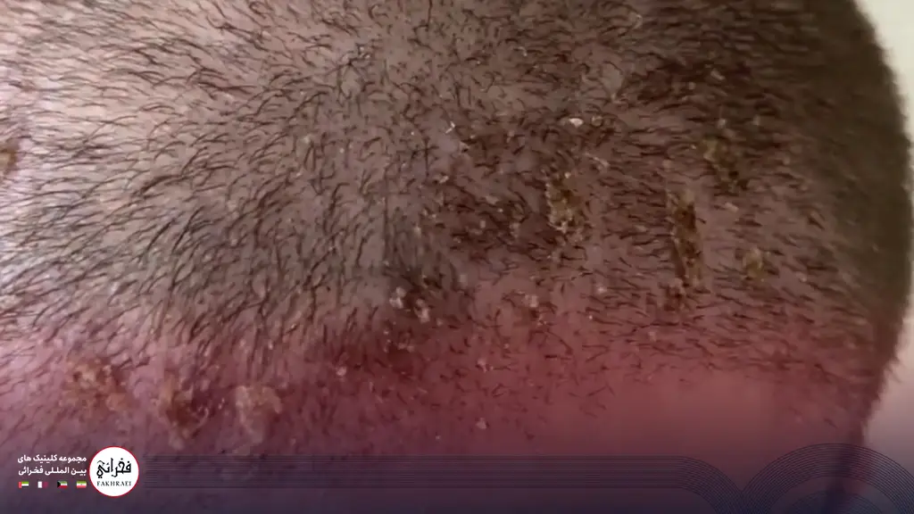 دلمه ها 14 روز پس از کاشت مو