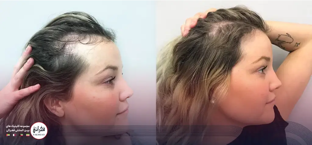 کاشت مو شقیقه برای بانوان