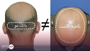کاشت مو با بانک موی ضعیف