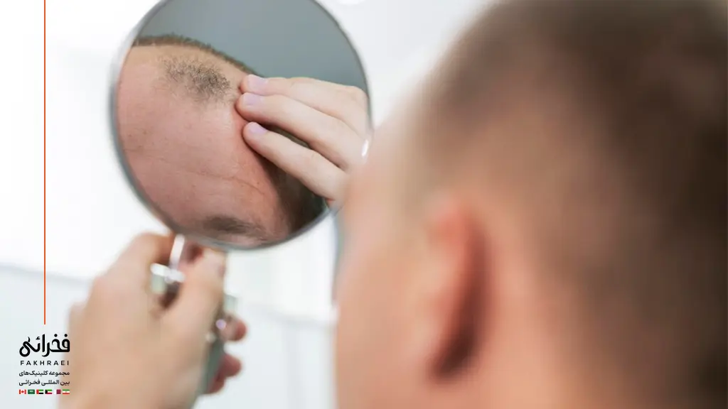 تصویر یک مرد مبتلا به ریزش موی سکه ای