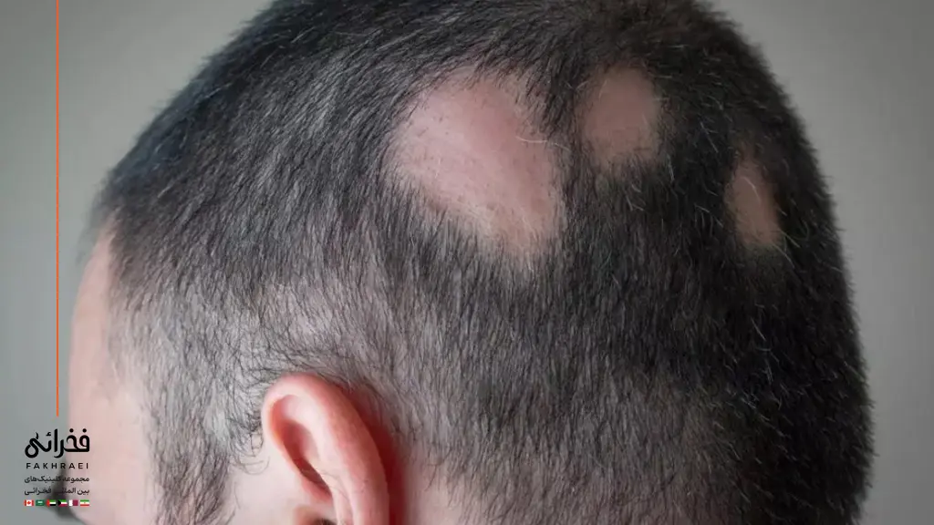 آلوپسی آره‌آتا روی سر یک آقا