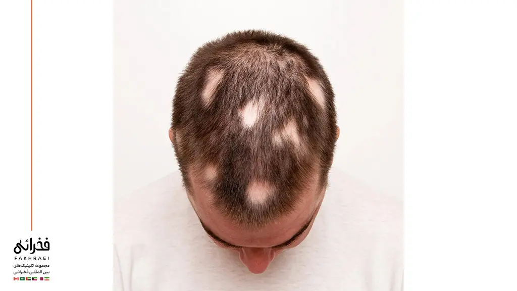 نشانه های ریزش موی سکه ای روی سر یک مرد