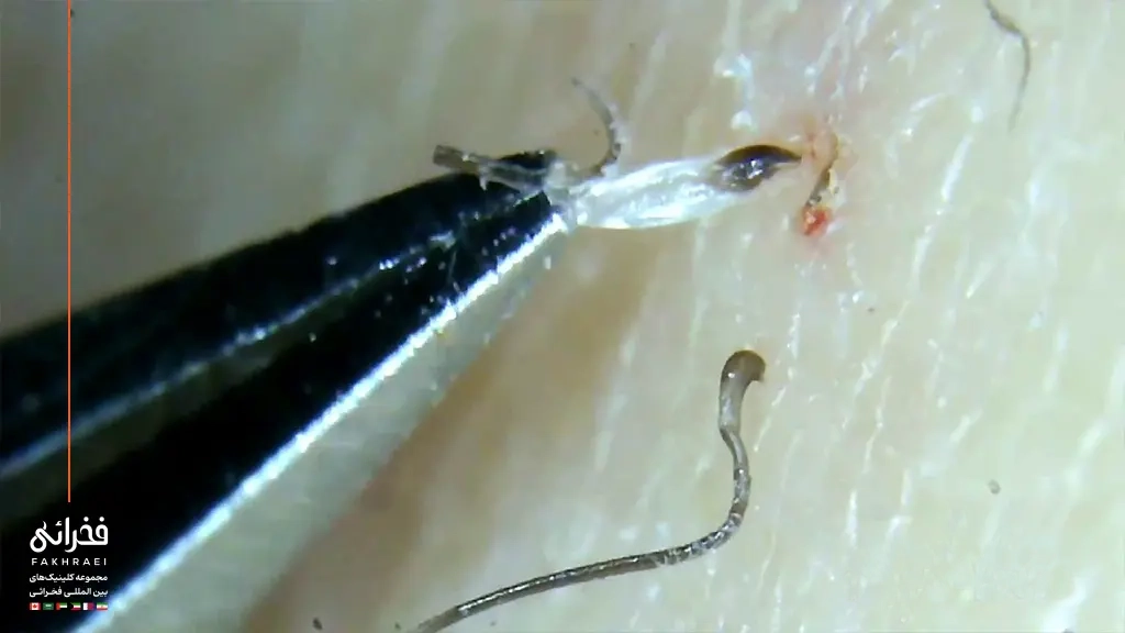 تصویر ریشه و فولیکول مو خارج شده از پوست