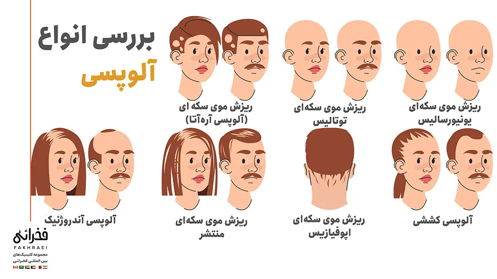 انواع آلوپسی یا ریزش موی سکه ای