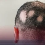 ریزش موی سکه‌ ای