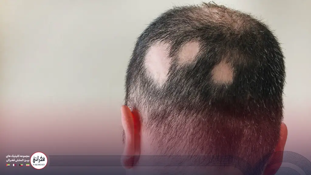 ریزش موی سکه ای