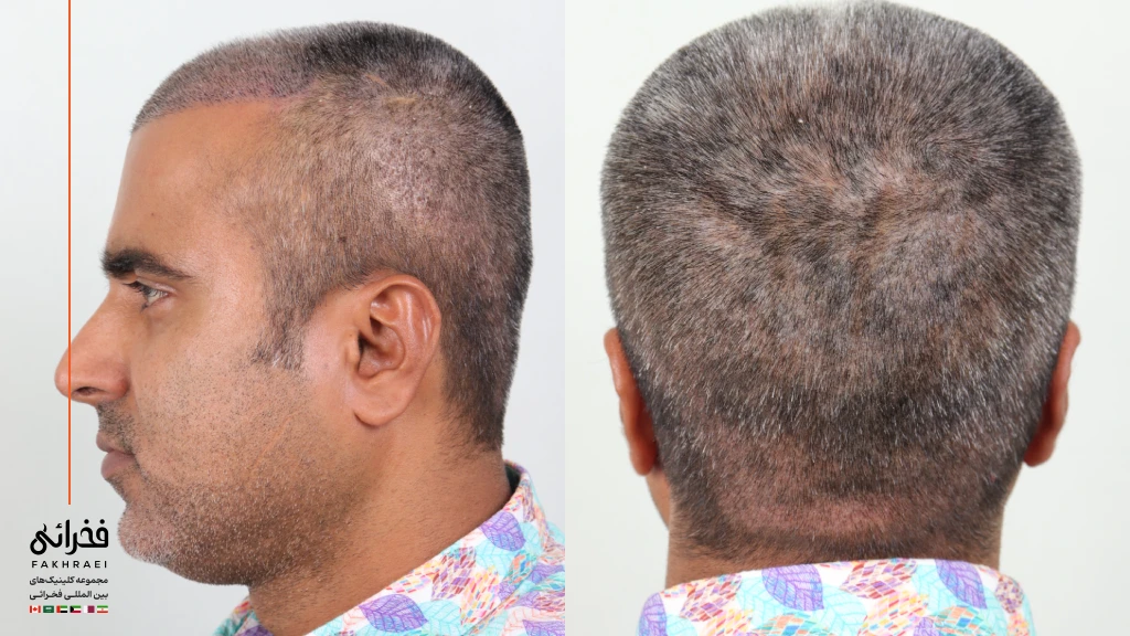 عکس بانک مو بعد از کاشت