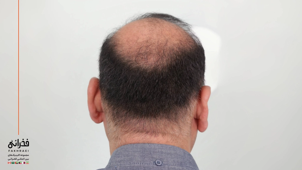 عکس بانک موی ضعیف