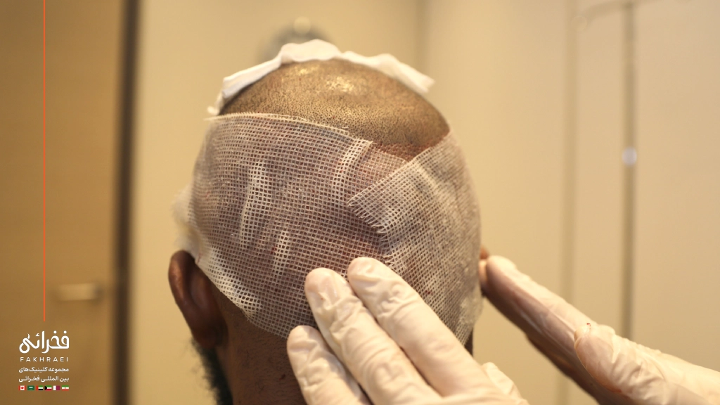 مراقبت‌های بانک مو پس از کاشت