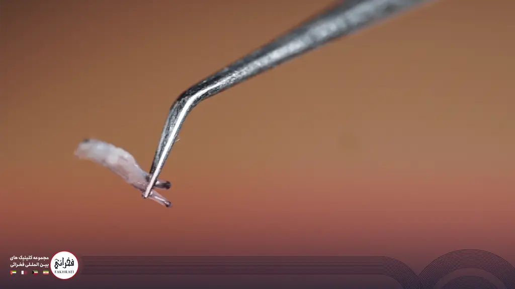 نقش کاشت مو در فولیکولهای مو