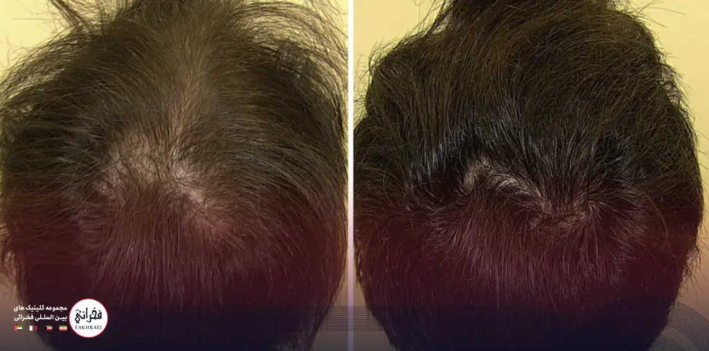 نتایج استفاده از ماینوکسیدیل