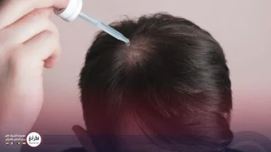 ماینوکسیدیل