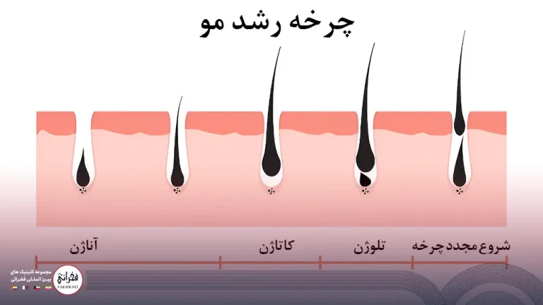 فاز استراحت در کاشت مو