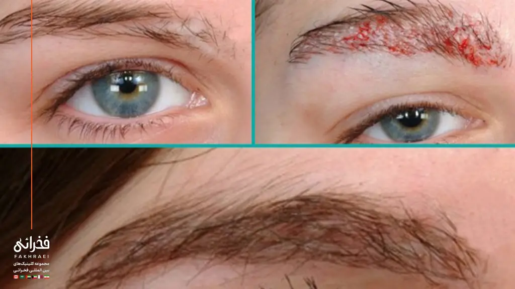 بررسی انواع عوارض کاشت مو طبیعی و خطرناک