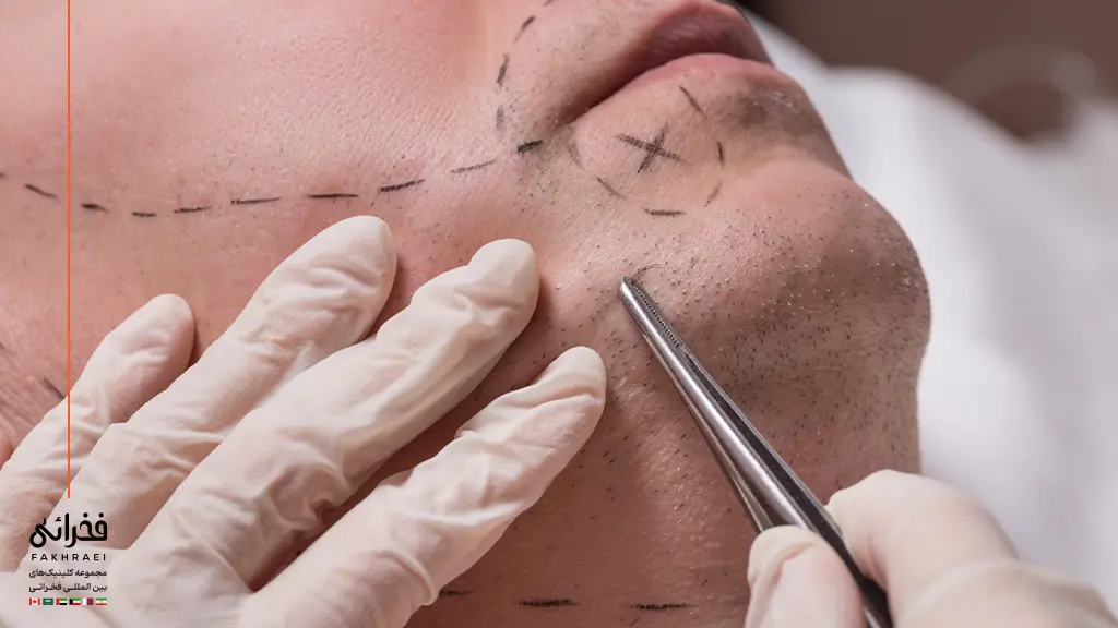 روش کاشت ریش و تاثیر آن بر هزینه کاشت ریش