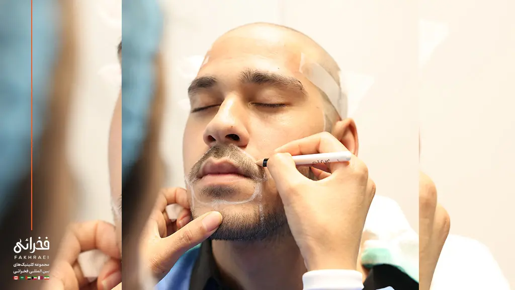 متخصص در حال بررسی هزینه کاشت ریش برای یک مرد