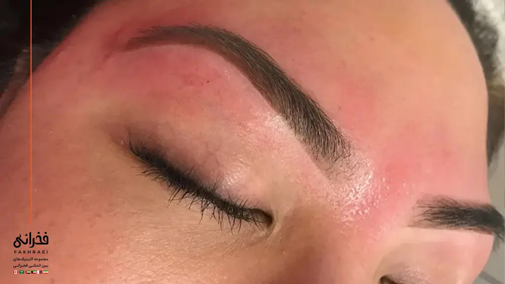 تورم و التهاب پس از کاشت ابرو