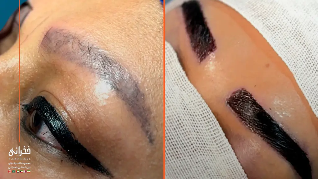 قیمت کاشت ابرو