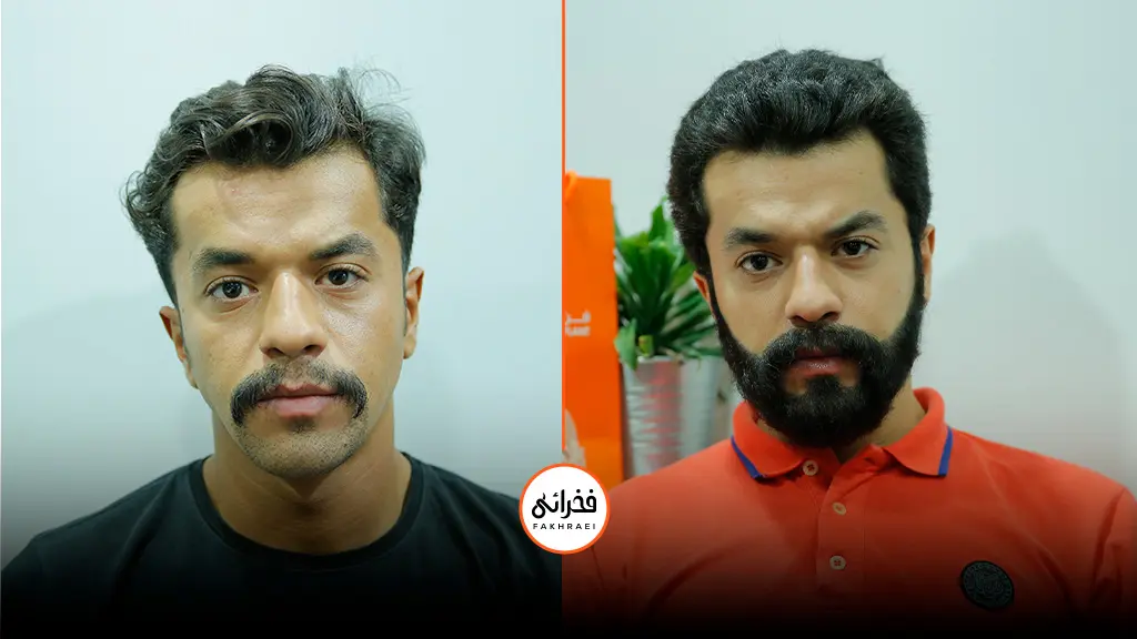 مقایسه قبل و بعد از کاشت ریش | قیمت و هزینه کاشت ریش طبیعی