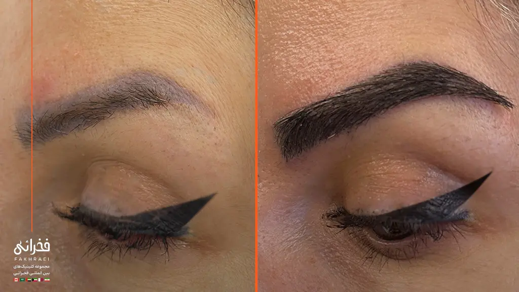 قبل و بعد از کاشت ابرو در کلینیک فخرائی