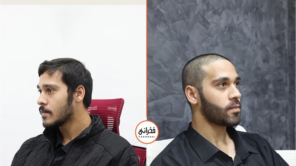 نتایج کاشت ریش طبیعی | بررسی هزینه کاشت ریش