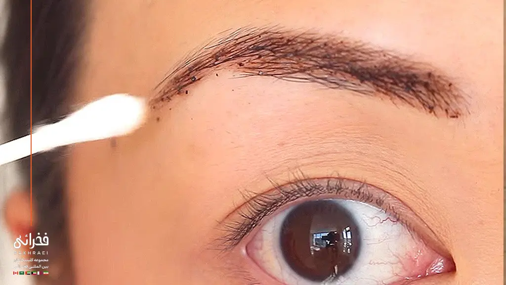 عدم هماهنگی رشد مو از عوارض کاشت ابرو