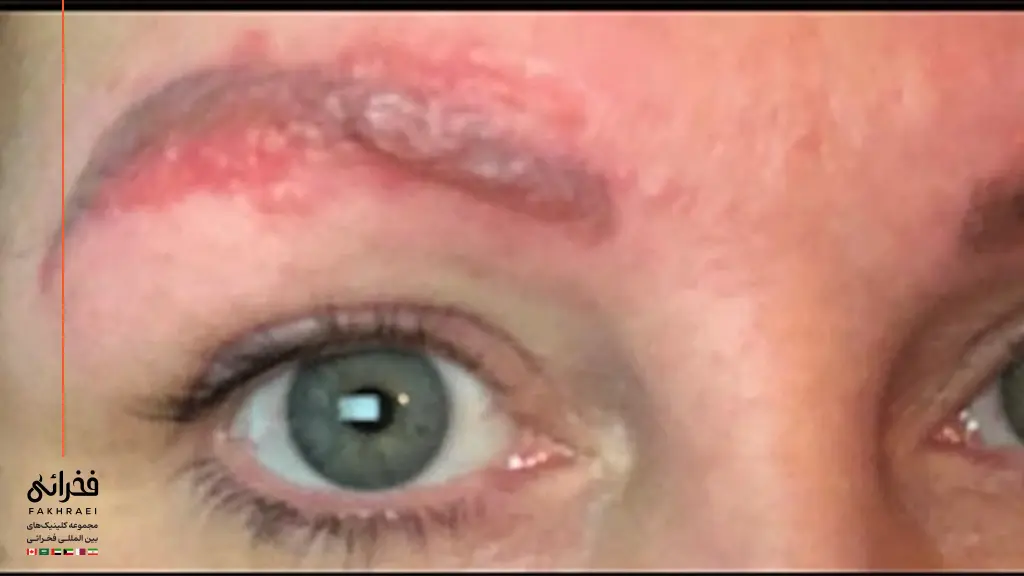 عفونت ابرو پس از کاشت