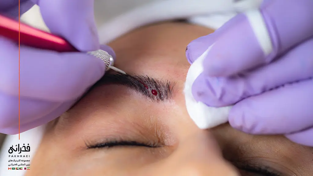 مرحله پیوند مو در کاشت ابرو