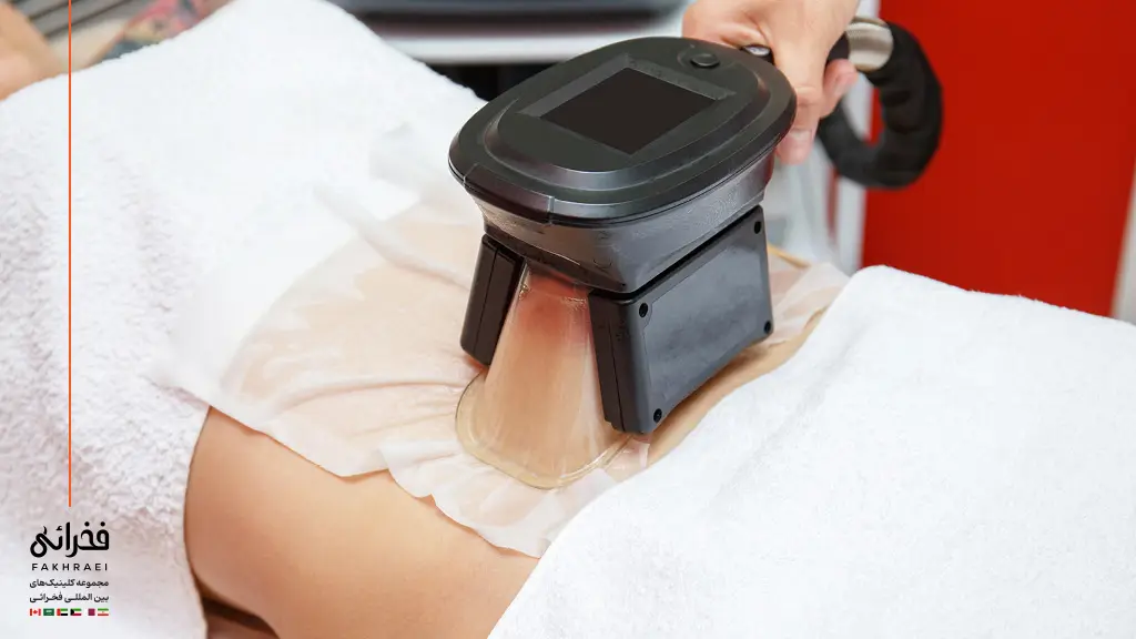 کرایولیپولیز