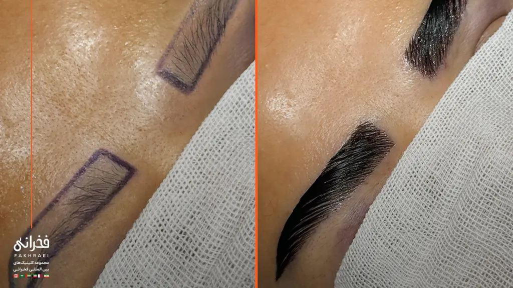 نتیجه نهایی پس از اتمام مراحل کاشت ابرو