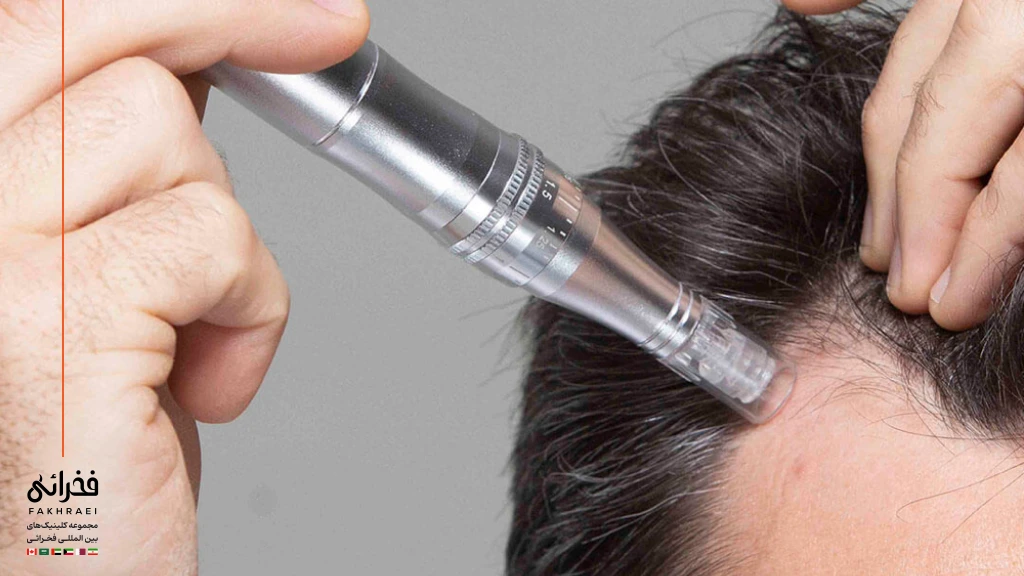 نحوه انجام میکرونیدلینگ مو