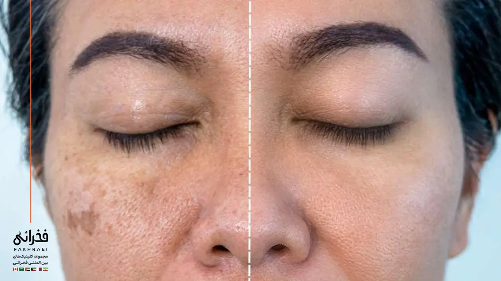 عکس قبل و بعد از مزوتراپی