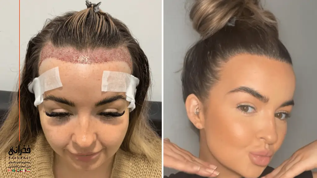 کاشت مو زنان