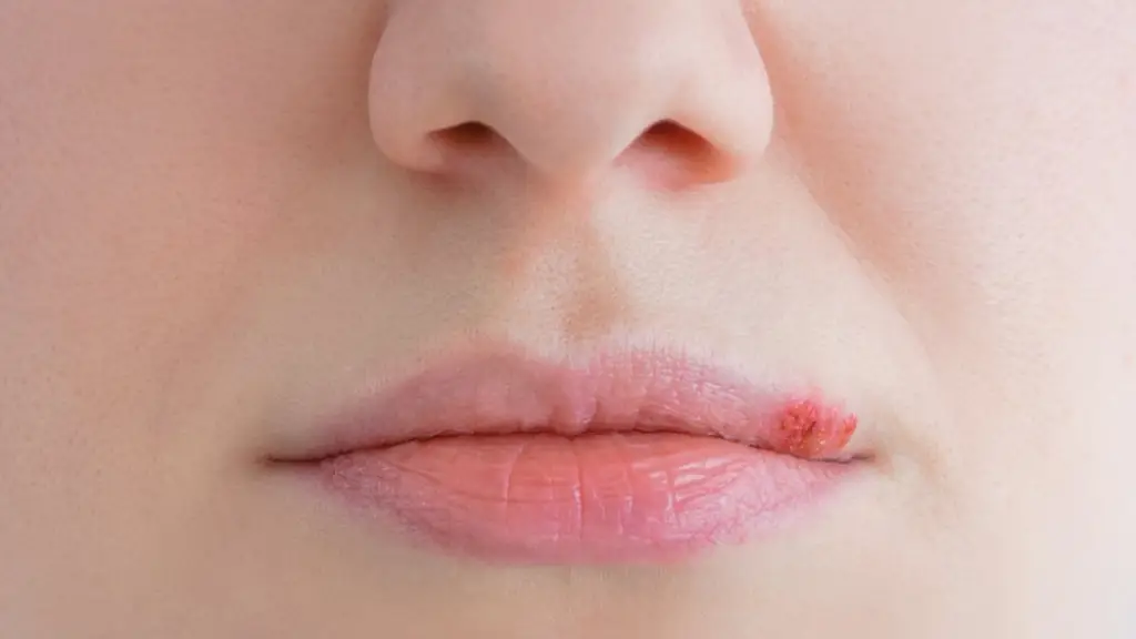 رفع تبخال در سه دقیقه