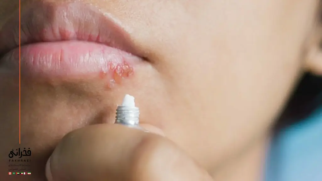 پماد آسیکلوویر برای درمان تبخال