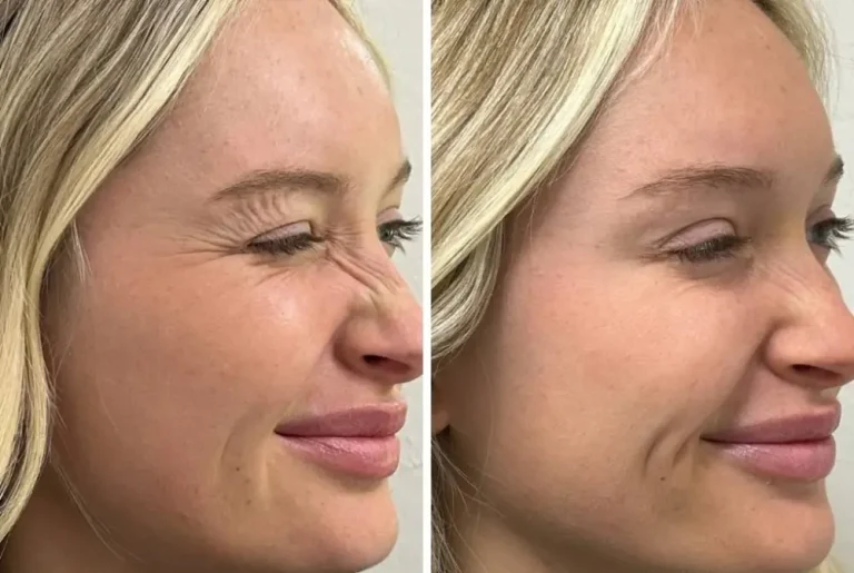 بوتاکس بینی