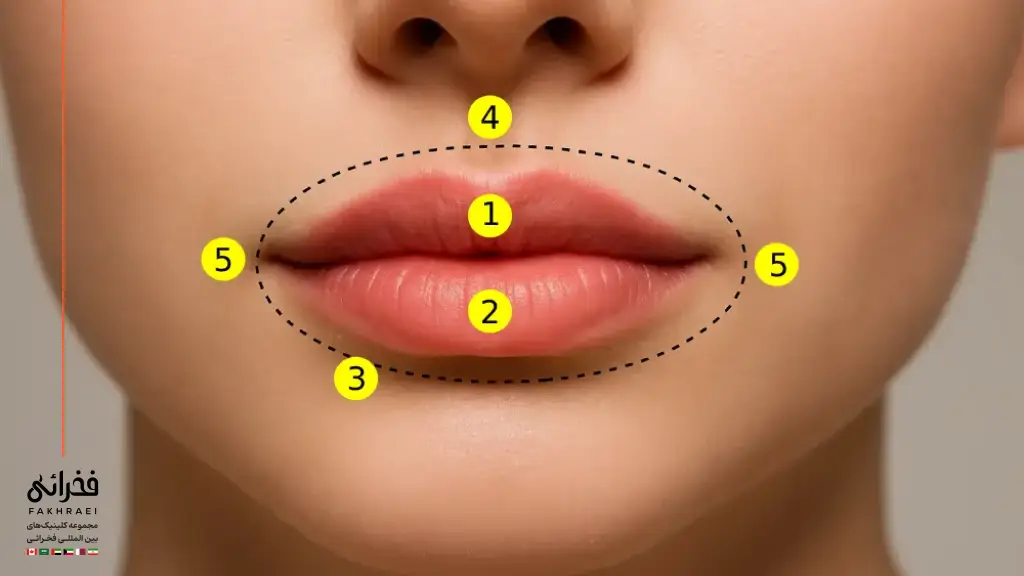 نقاط تزریق بوتاکس لب
