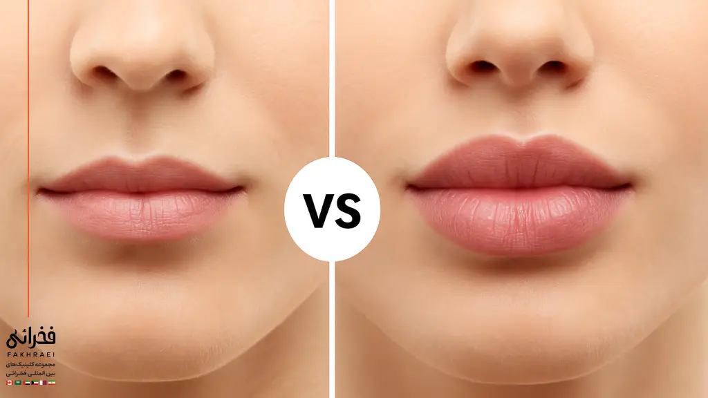 تفاوت بوتاکس لب و فیلر لب