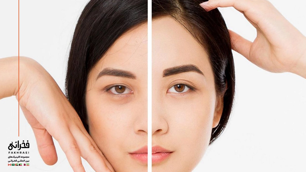 لیفت شقیقه با بوتاکس-قبل و بعد لیفت شقیقه با بوتاکس
