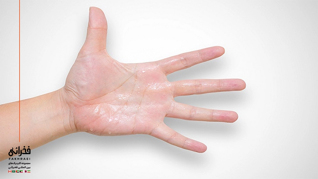 تعریق کف دست
