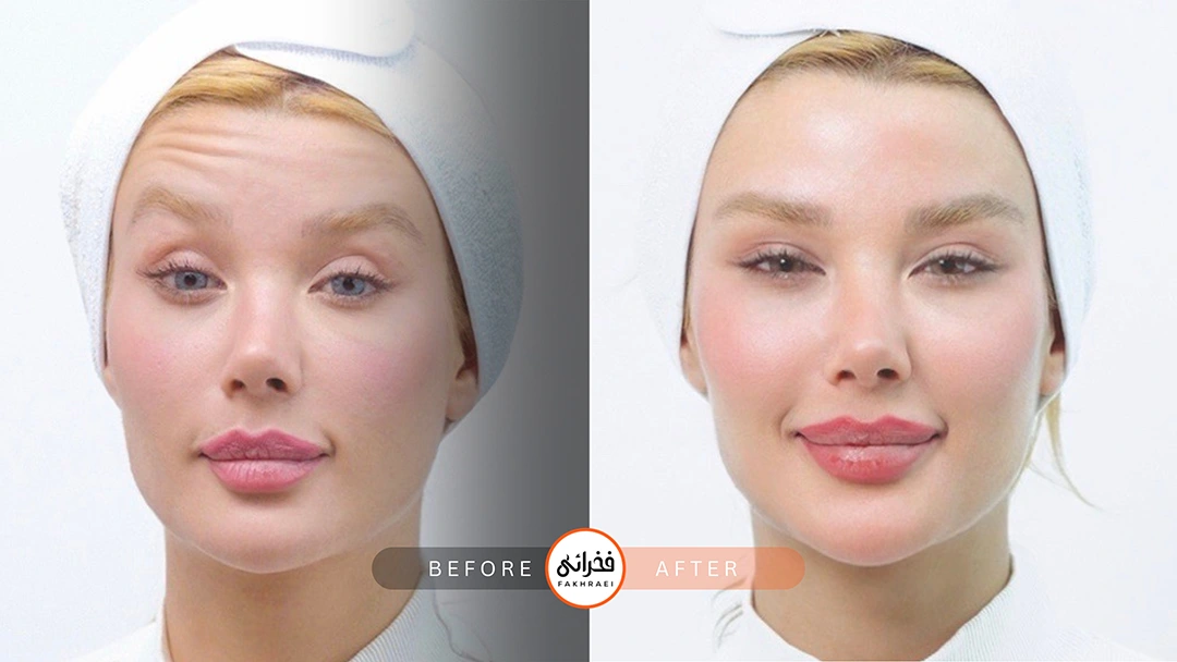 لیفت شقیقه با بوتاکس