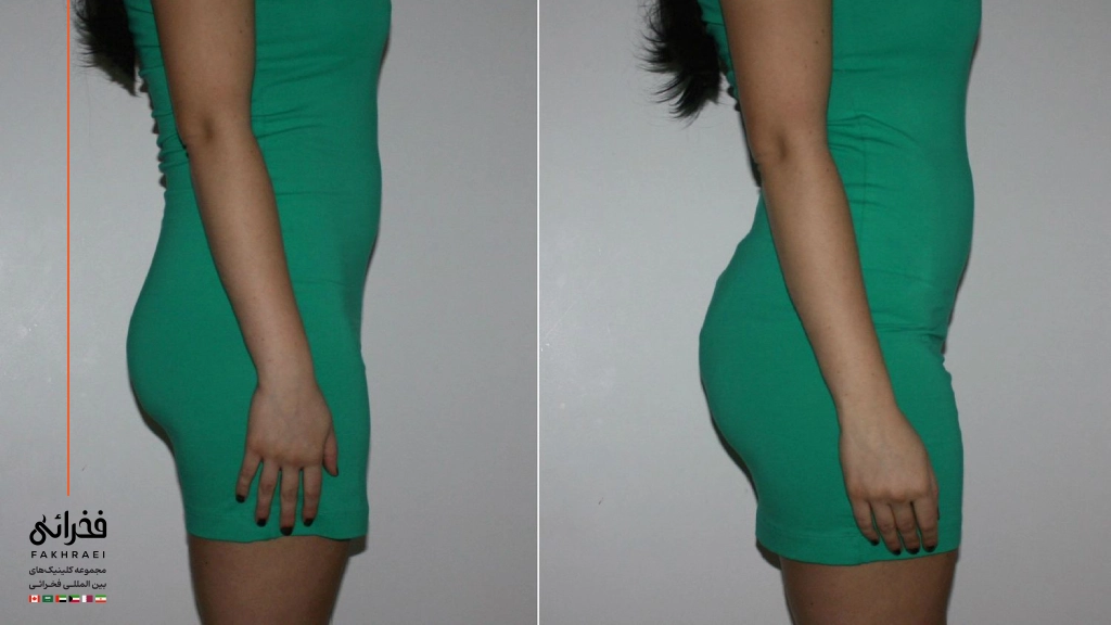 فیلر بادی برای باسن